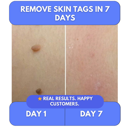 Say Goodbye to Skin Tags — From Home