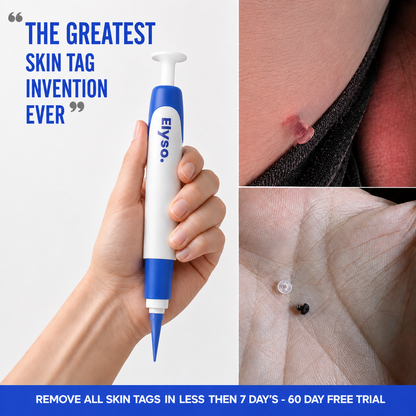 Say Goodbye to Skin Tags — From Home